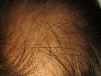 bald spot